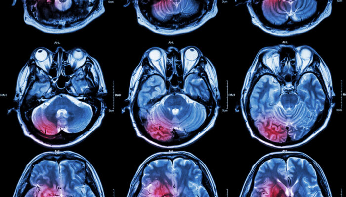 Signs of a Brain Tumor, Part 1: The Frontal Lobes