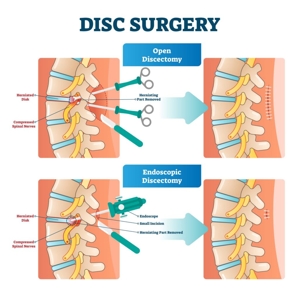 Disc surgery vector illustration. Diagram with back nerv