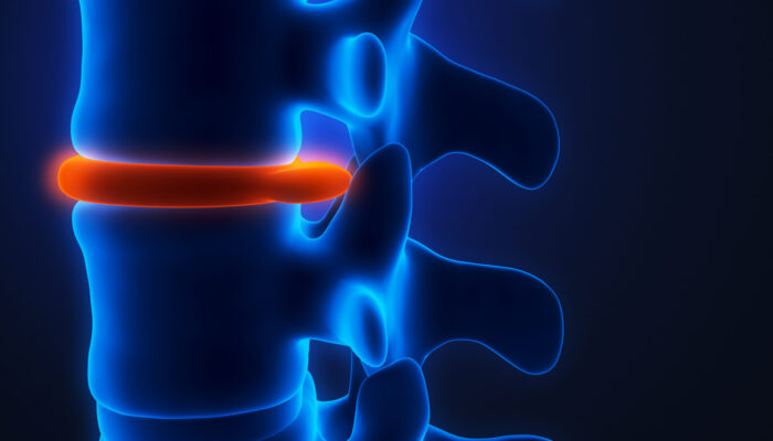 Spinal Solutions: Discectomy