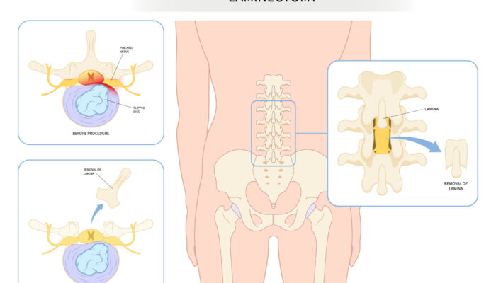 Spinal Solutions: Laminectomy