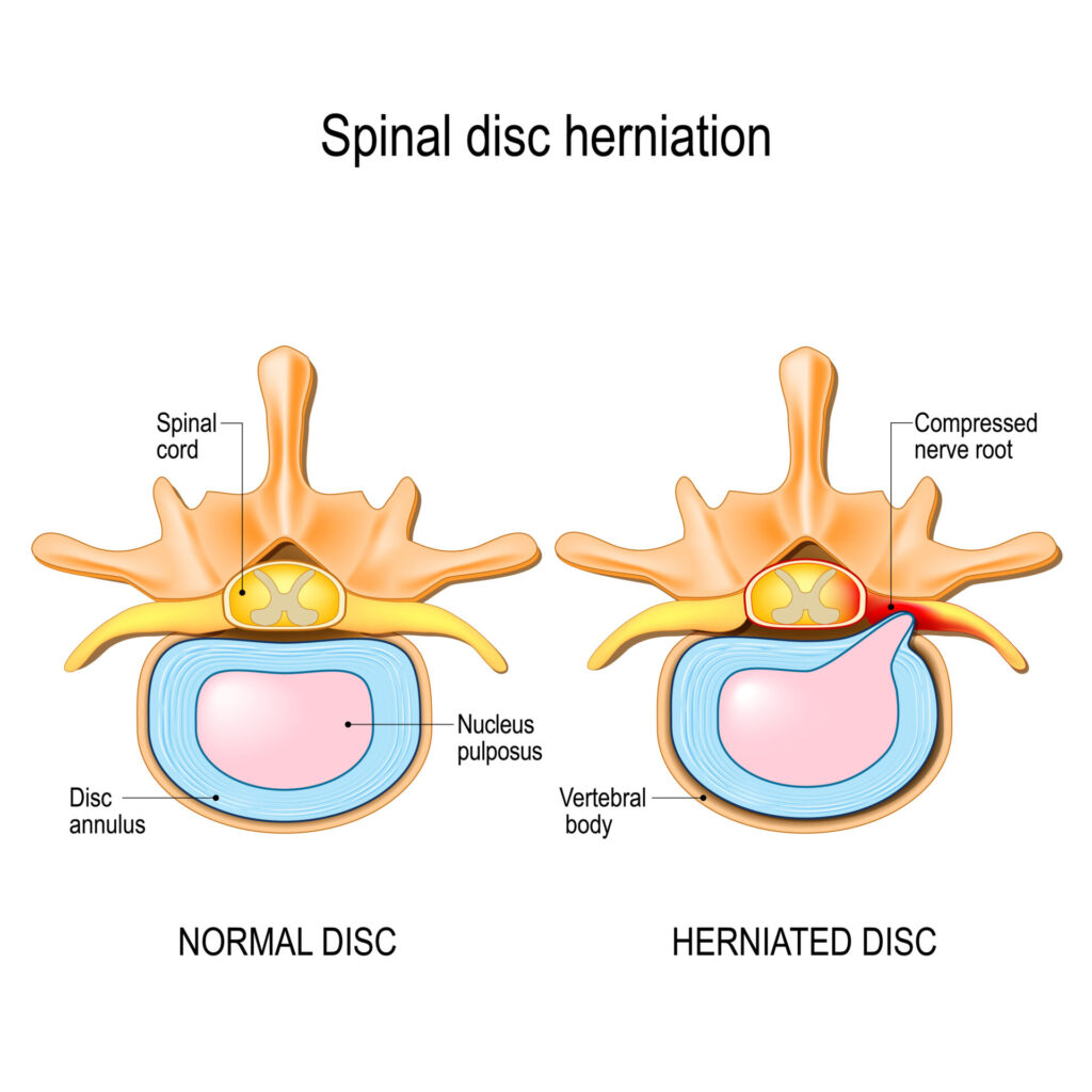 Normal disc and spinal disc herniation in cervical vertebrae.
