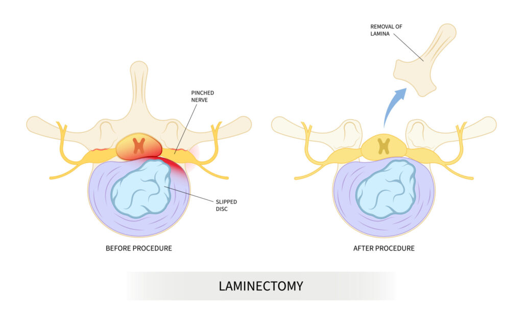 vertebrae back pain lumbar of diskectomy laminectomy spine cord