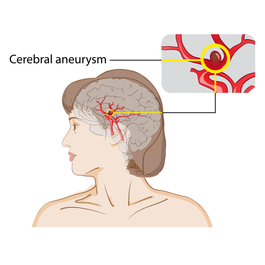 What Is a Brain Aneurysm?