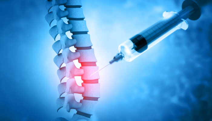 Types of Spinal Injections for Back Pain