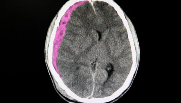 What Is a Hematoma? Types of Hematomas in the Brain