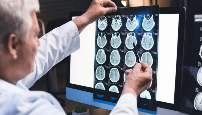 4 Facts About Brain Hematomas