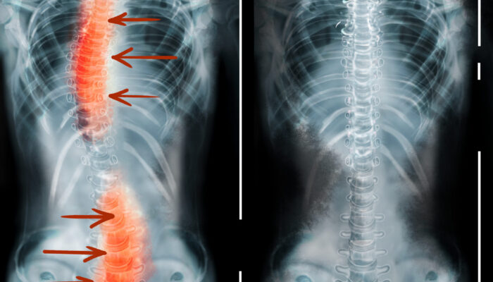 What to Expect After Scoliosis Surgery